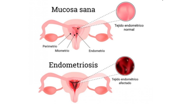 ovarios con endometriosis